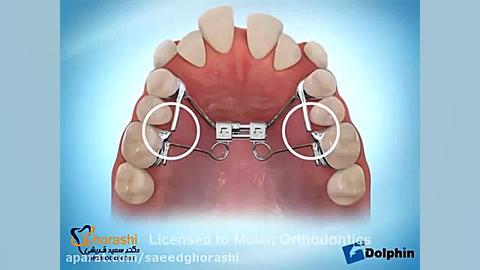 تنگی فک بالا- دکتر سعید قریشی دکتر سعید قریشی