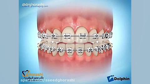الاستیک- دکتر سعید قریشی دکتر سعید قریشی