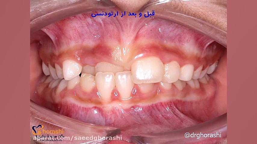 تغییرات تدریجی دندان ها-دکتر سعید قریشی دکتر سعید قریشی