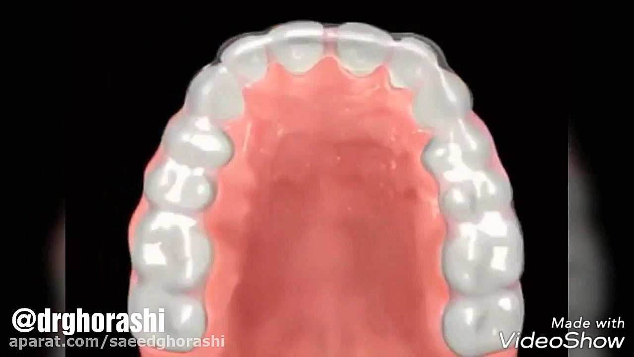 پلاک شفاف یا ارتودنسی نامرئی - دکتر سعید قریشی دکتر سعید قریشی