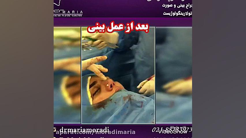 فیلم عمل زیبایی بینی لنز تماسی دارورسان
