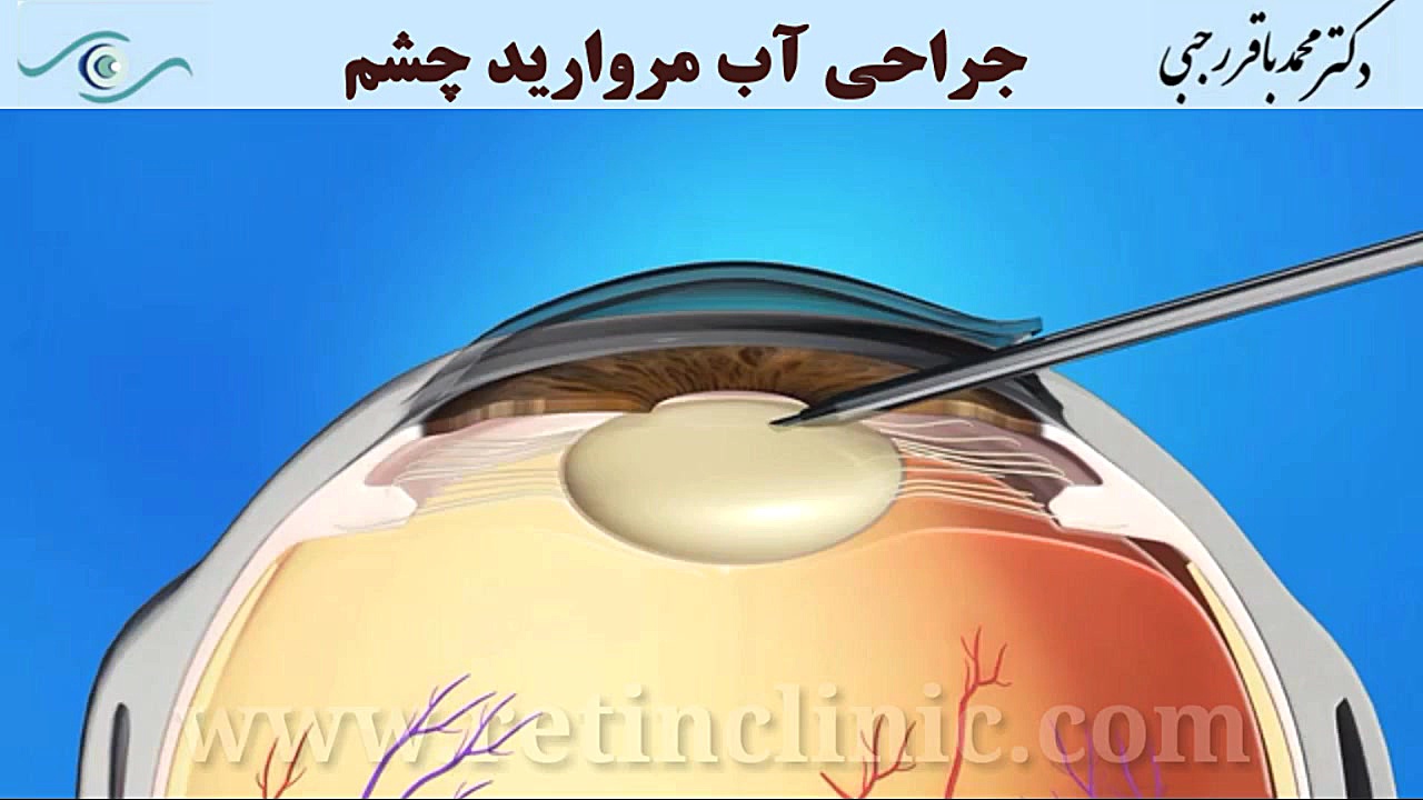 جراحی آب مروارید بررسی لک صورت