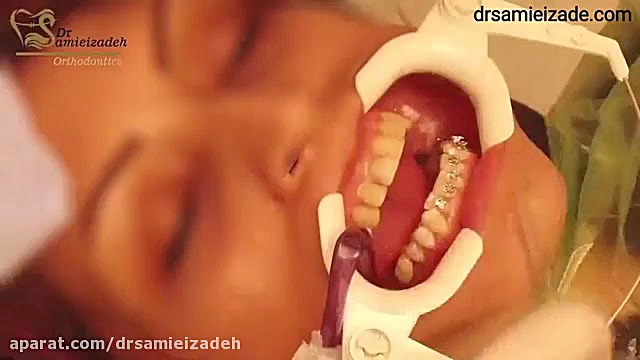 مراحل براکت گذاری در درمان ارتودنسی ثابت دکتر فاطمه سمیعی زاده