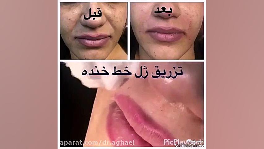 تزریق ژل در خط خنده دکتر حمیده آقایی