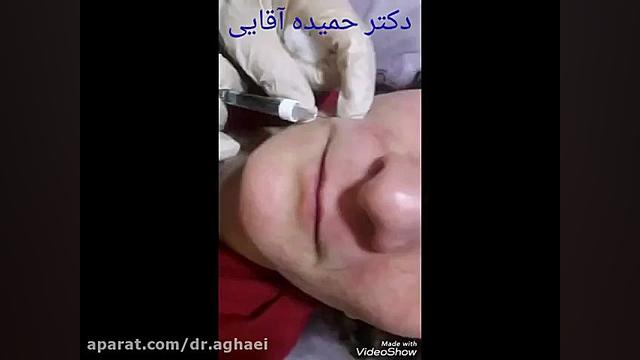 تزریق ژل خط خنده دکتر حمیده آقایی