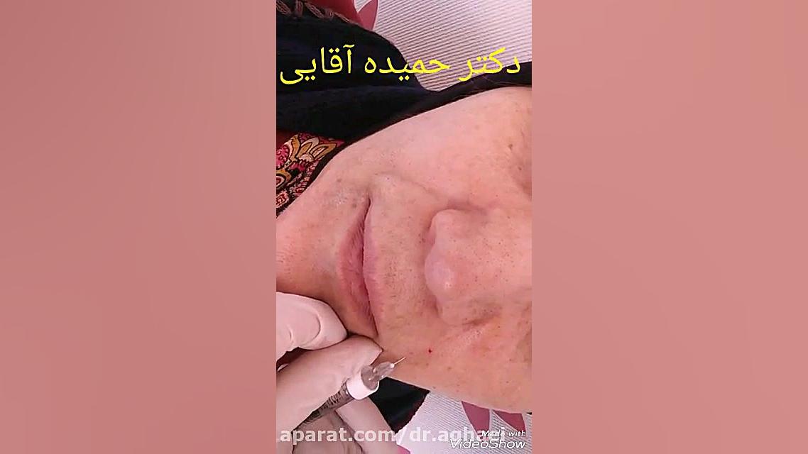 تزریق ژل خط خنده دکتر حمیده آقایی