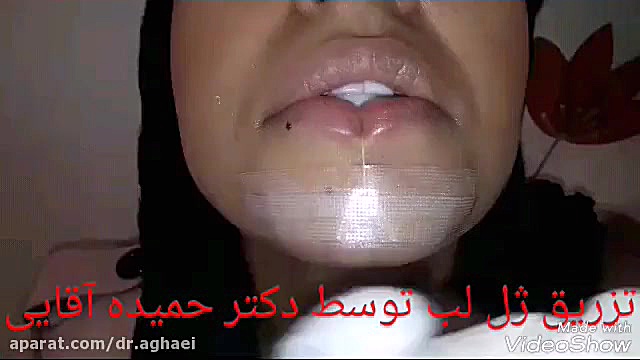 تزریق ژل لب دکتر حمیده آقایی