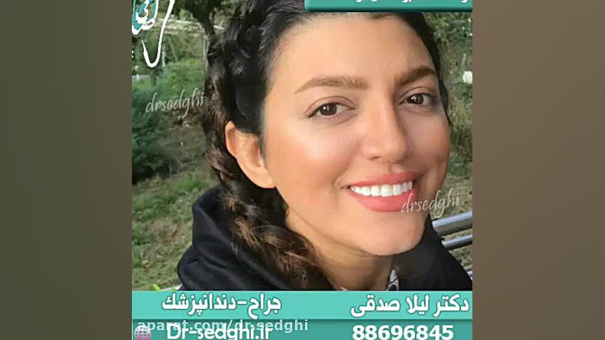 نمونه کامپوزیت ونیر دکترلیلا صدقی مگالودکس