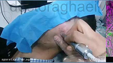 میکرونیدلینگ دکتر حمیده آقایی