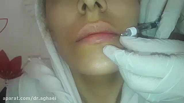 تزریق ژل لب دکتر حمیده آقایی