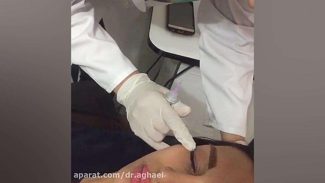 کربوکسی تراپی دکتر حمیده آقایی