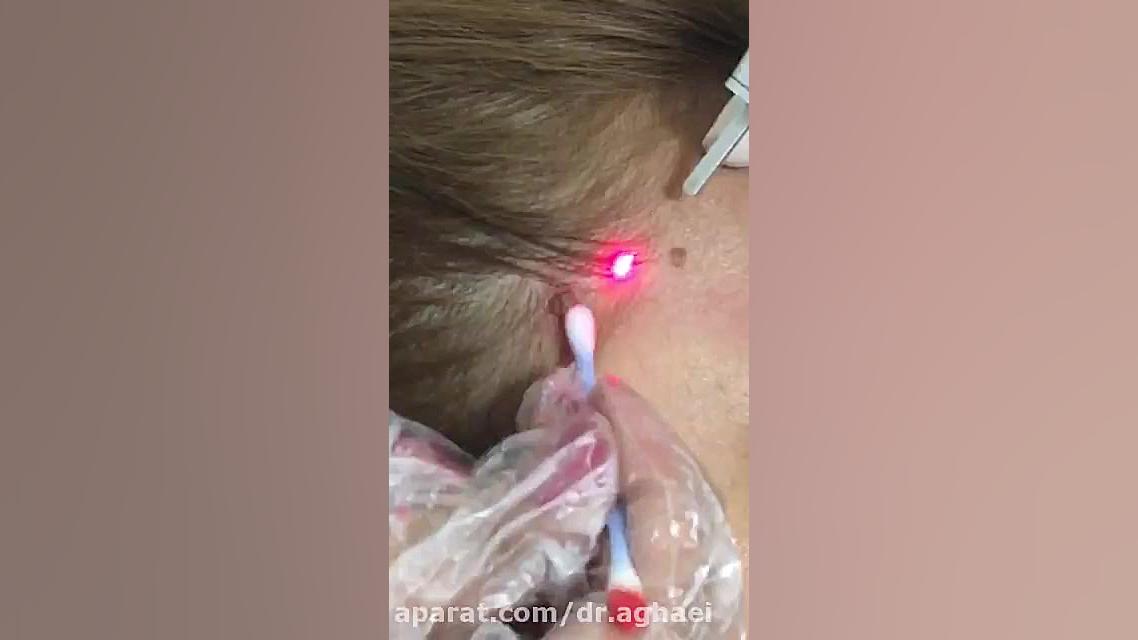 رفع خال با لیزر c02 دکتر حمیده آقایی