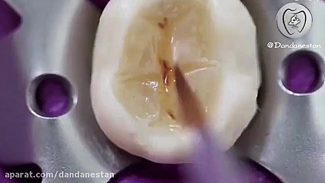 پر کردن دندان | دندانستان دستگاه DNA-Chip