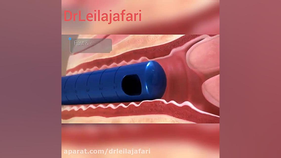 جراحی زیبایی واژن دکتر لیلا جعفری