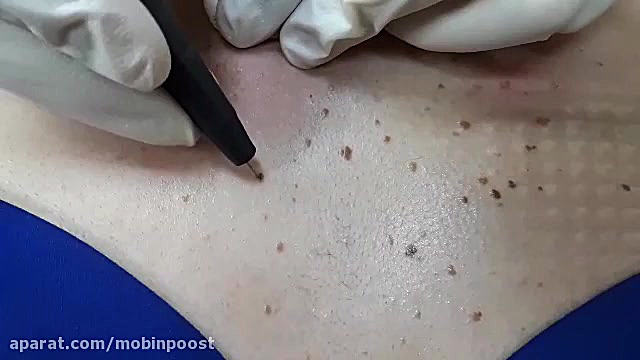 برداشت توده پوستی در ناحیه قفسه سینه - بخش اول لیپوساکشن
