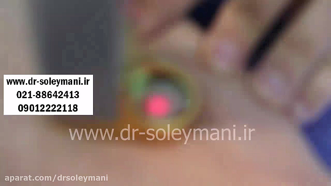 درمان ضایعات عروقی دکتر امیر سلیمانی