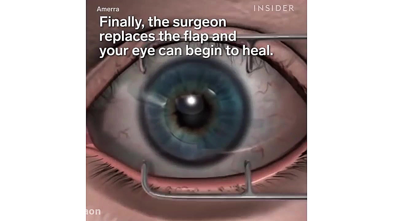 جراحی چشم لیزیک ساکوبیتریل