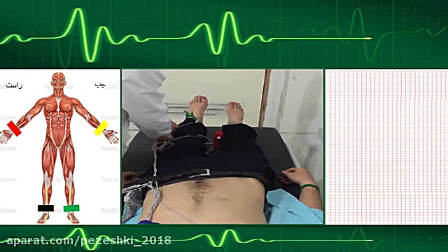 گرفتن نوار قلبی (ECG) دیدنی کربوکسی تراپی