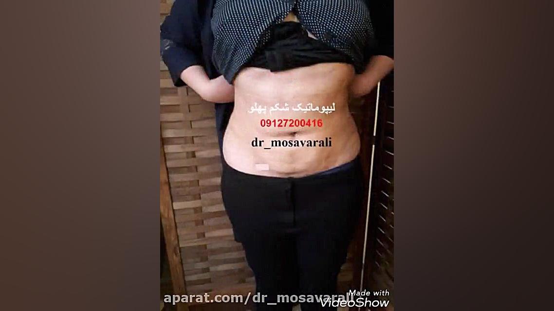 لیپوماتیک شکم پهلو دستگاه لیزر پالس فمتوثانیه