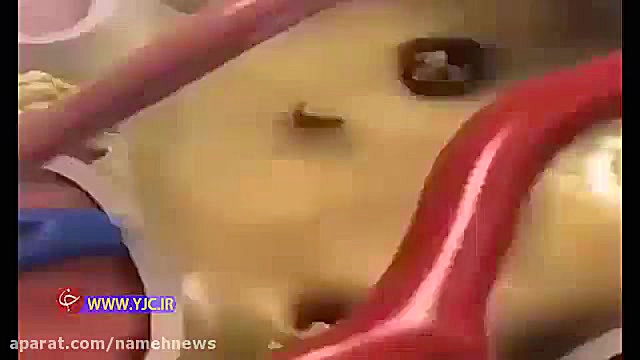 چگونگی تشکیل سنگ کلیه کلینیک پوست