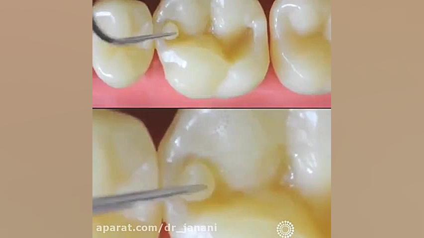 ترمیم همرنگ دندان الکترود اپتوژنزی