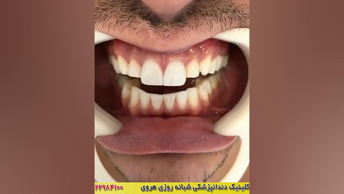لمینت دندان | ونیر دندان | کامپوزیت دندان لاروتریکتینیب