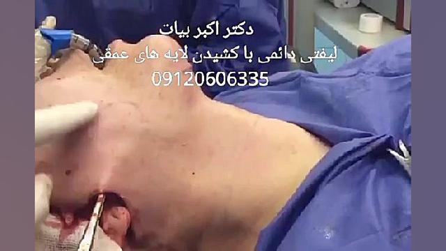 جراحی لیفت صورت و گردن والسارتان
