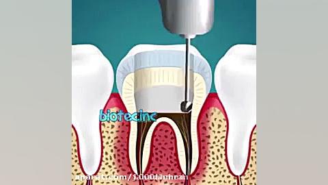دستیار کنار دندانپزشکی (آموزش عصب کشی و ترمیم دندان) تست مهار دگزامتازون
