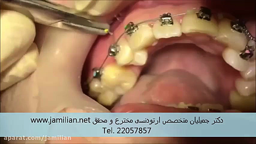 ارتودنسی ثابت دکتر عبدالرضا جمیلیان - متخصص ارتودنسی