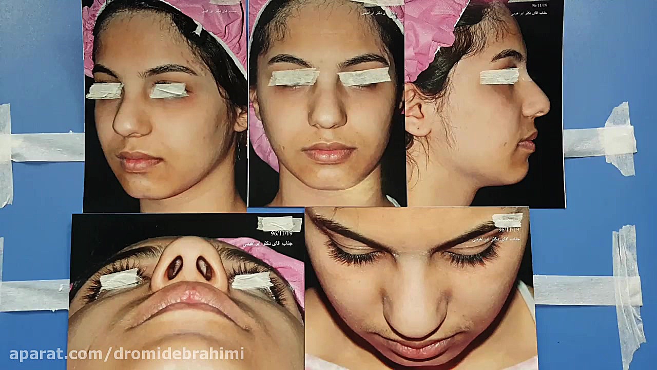 نمونه کار بهترین جراح بینی تهران، دکتر امید ابراهیمی دکتر امید ابراهیمی