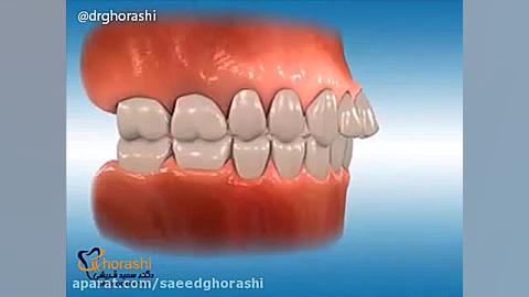 درمان عقب بودن فک - دکتر سعید قریشی دکتر سعید قریشی