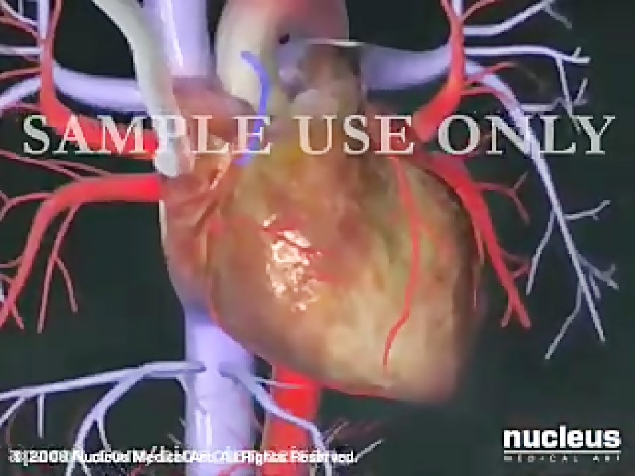 Heart Bypass Surgery (CABG)