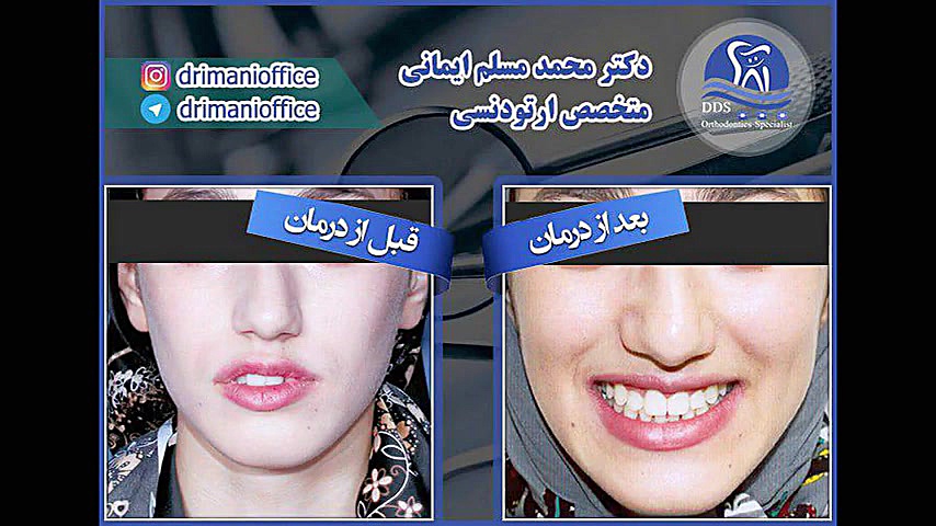 کیس درمانی شماره 1 دکتر محمد مسلم ایمانی - متخصص ارتودنسی در کرمانشاه