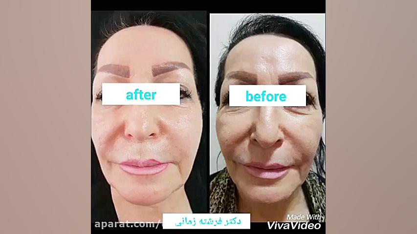 لیفت صورت با نخ كاگ لیزر فرکشنال