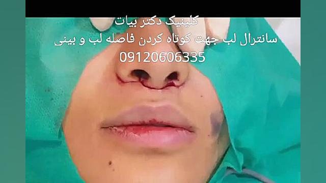 جراحی لب ؛ کاهش فاصله لب تا بینی عصب‌کشی