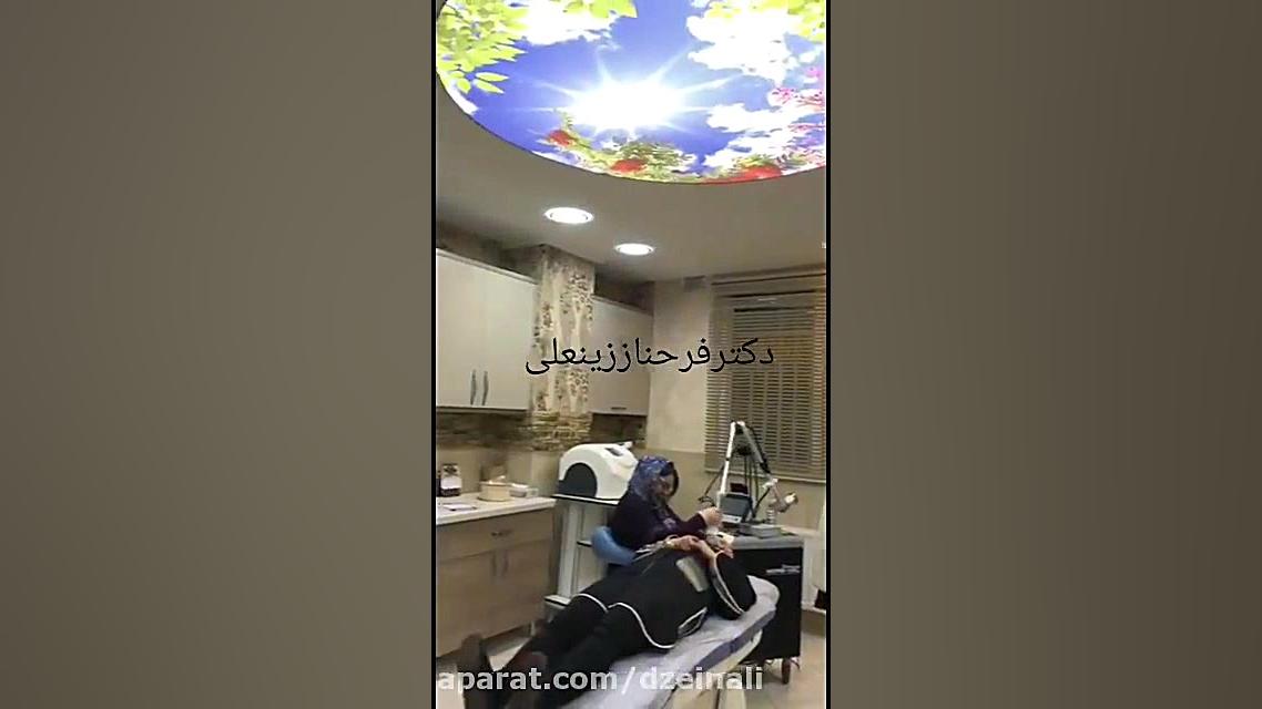 لیزر فرکشنال co2 برای رفع لک و جای آکنه و جوانسازی پوست دکتر فرحناز زینعلی - متخصص پوست، مو، زیبایی زنجان
