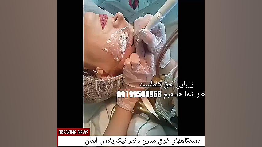 عمل سرپایی بلفاروپلاستی ( رفع افتادگی پلک) با دستگاه فوق مدرن پلاسماجت دکتر نیک جراحی لثه