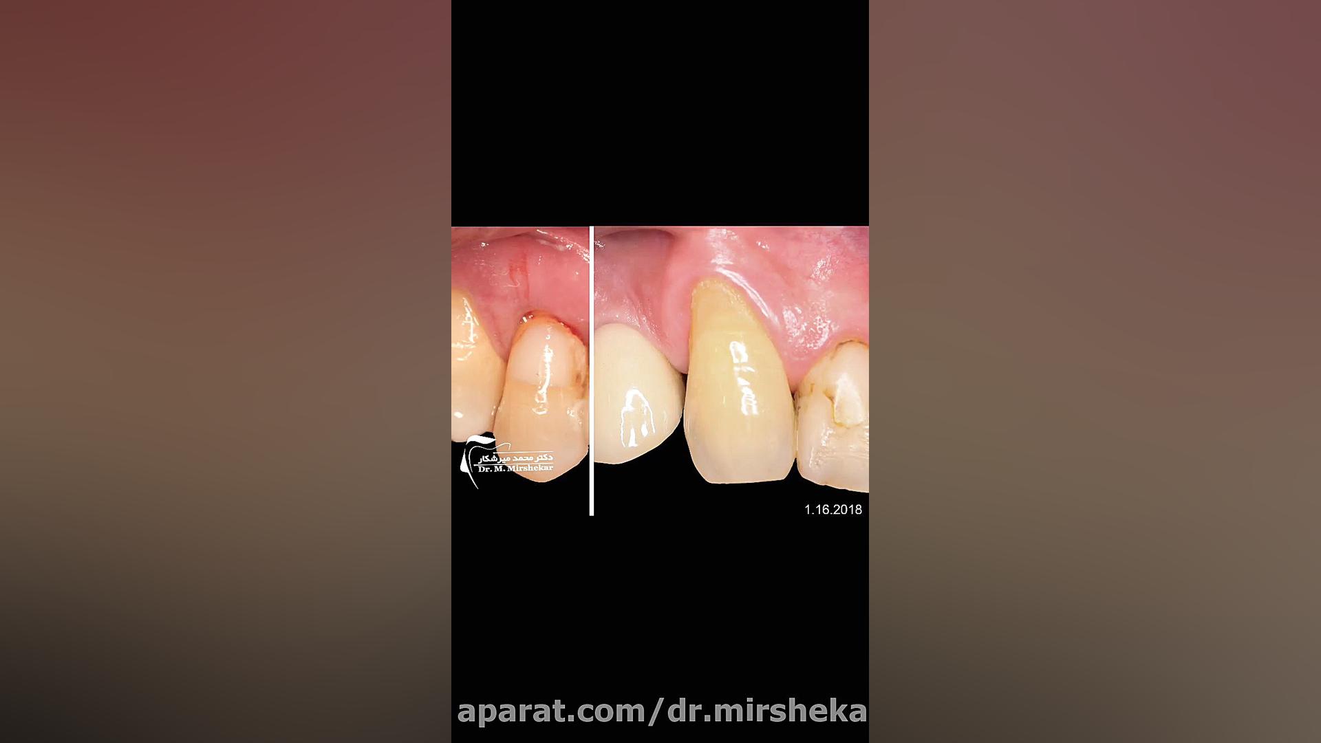 جراحی پیوند لثه FVC