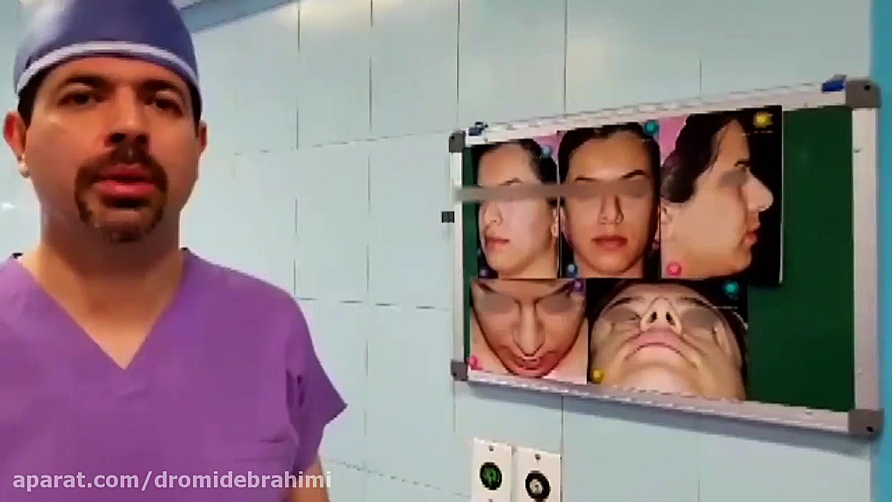 نمونه کار بهترین جراح بینی تهران، دکتر امید ابراهیمی دکتر امید ابراهیمی