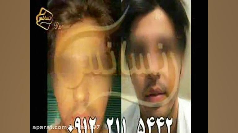 فیلم کاشت ریش و سبیل به روش SUT مرکز مو رنسانس پرمترکسد