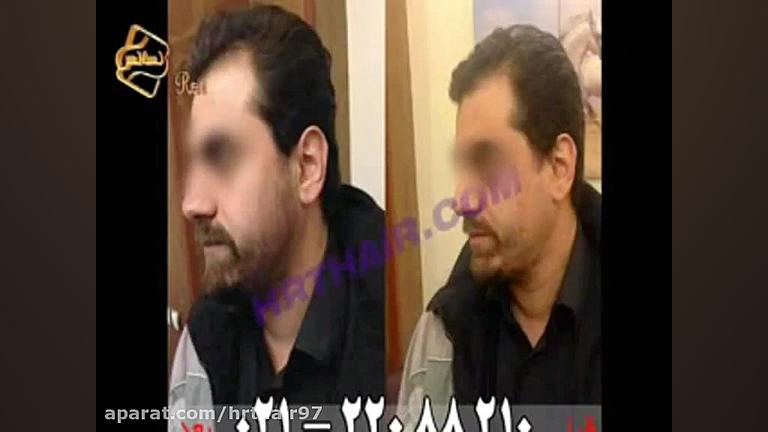 فیلم کاشت ریش و سبیل به روش SUT مرکز مو رنسانس انسریدا