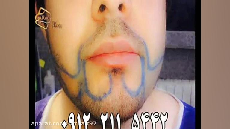 فیلم کاشت ریش و سبیل به روش SUT مرکز مو رنسانس برداشتن خال گوشتی