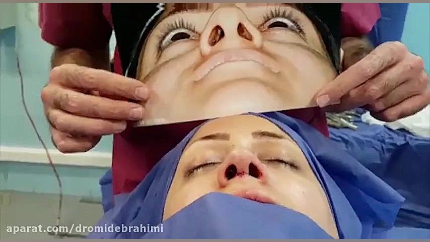 نمونه کار بهترین جراح بینی تهران، دکتر امید ابراهیمی دکتر امید ابراهیمی
