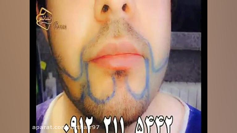فیلم کاشت ریش و سبیل به روش SUT مرکز مو رنسانس سندرم تریشن-کولینز نادر
