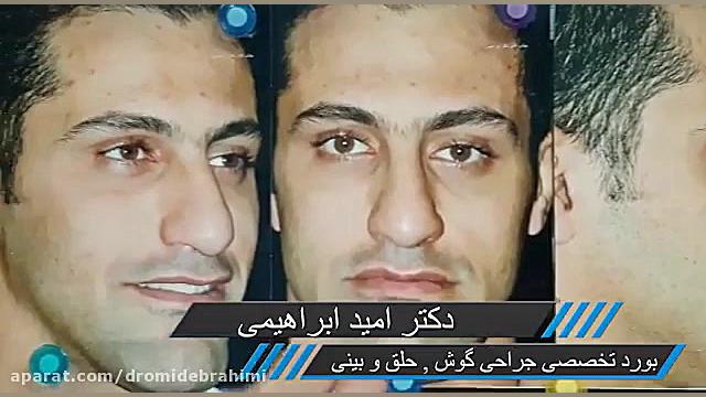 نمونه کار بهترین جراح بینی تهران، دکتر امید ابراهیمی دکتر امید ابراهیمی