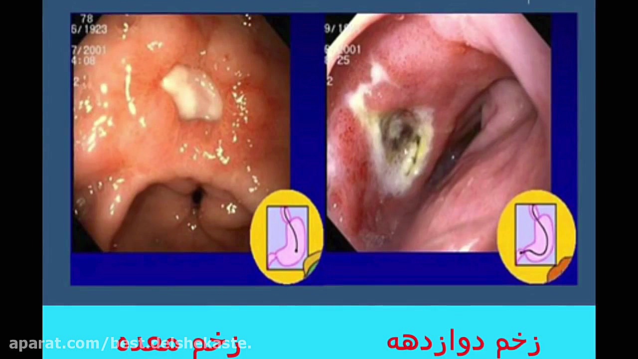 زخم معده ترمیم ونیر