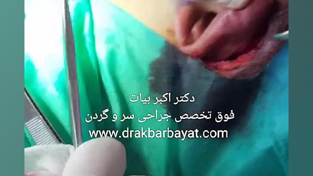 جراحی گوش برجسته ایم‌دولیموماب