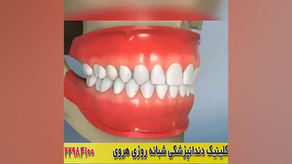 ترمیم دندان / انیمیشن منافذ باز پوست