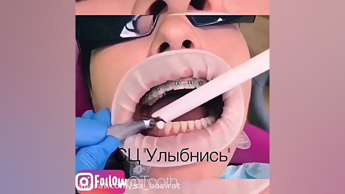باز کردن ارتودنسی پروتز سینه