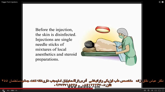 نقاط ماشه ای وتزریق آن-دکتر دقاق زاده-متخصص طب فیزیکی آر اف فرکشنال